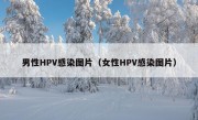 男性HPV感染图片（女性HPV感染图片）